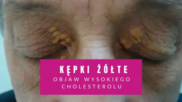 Żółte kępki na powiekach, widoczne na zbliżeniu.