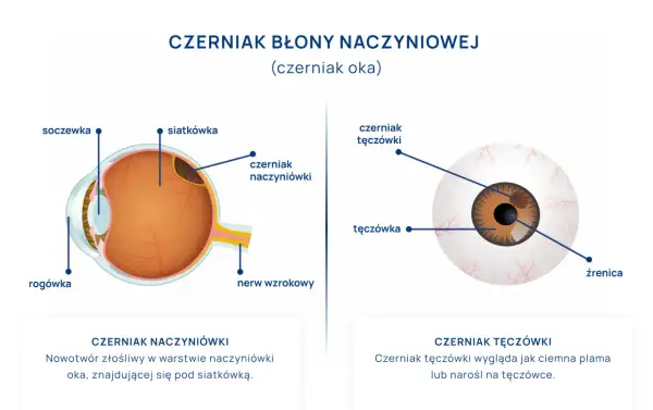 Ilustracja przekroju oka z zaznaczonym czerniakiem naczyniówki oraz widok oka z czerniakiem tęczówki.