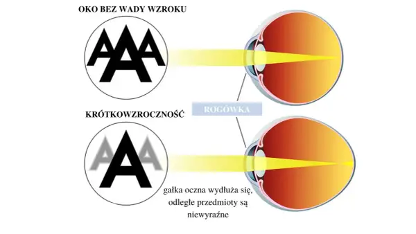 Czy wada wzroku może się zmniejszyć? Odkryj prawdę o poprawie widzenia