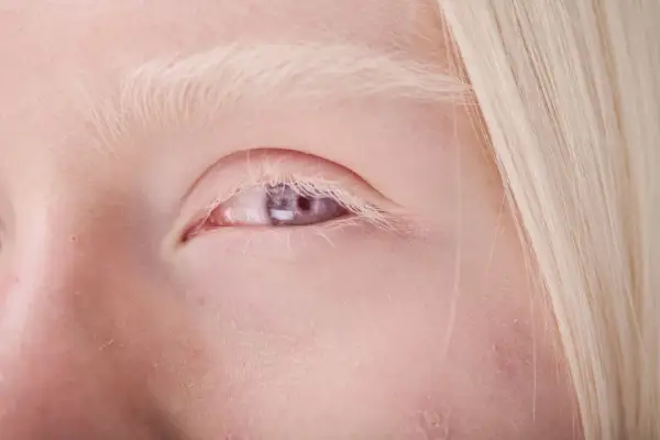 Zbliżenie oka osoby z albinizmem, z widoczną jasną skórą, blond brwiami i rzęsami oraz fioletową tęczówką.