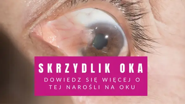 Zbliżenie na oko z widocznym skrzydlikiem.