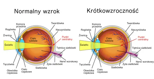 Schemat oka z normalnym wzrokiem i krótkowzrocznością. Czy wada wzroku minus może się cofnąć? Ilustracja pokazuje różnice w ogniskowaniu światła.